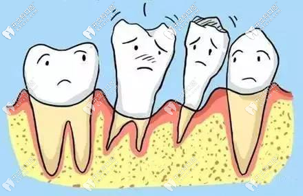 牙周病导致牙齿松动影响正畸