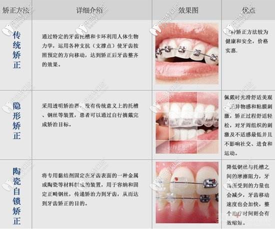 牙齿矫正的各种方式