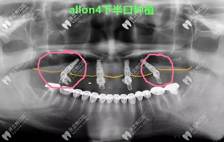 做allon4下半口种植牙真人案例CT照