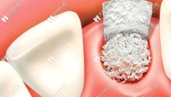 种植牙手术中骨粉和骨膜