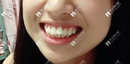 骨性+牙性龅牙,咬合有问题 骨性+牙性龅牙,咬合有问题