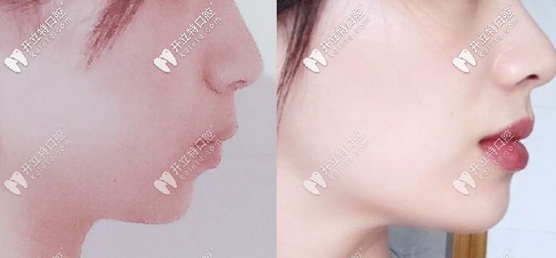 凸嘴戴钢牙套的侧脸变化图 凸嘴戴钢牙套的侧脸变化图