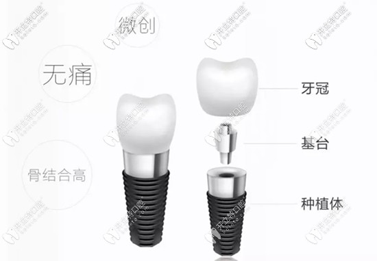 种植牙的咬合力是非常接近真牙的 种植牙的咬合力是非常接近真牙的