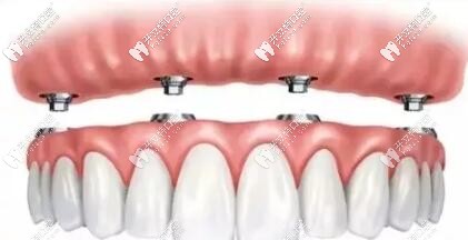 all-on-4半全口种植牙