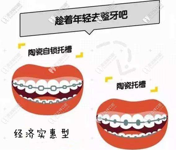 经济实惠型—陶瓷自锁托槽 经济实惠型—陶瓷自锁托槽