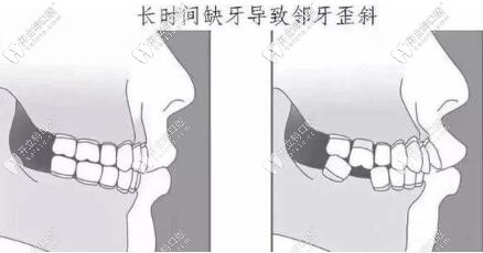 缺牙不种的危害