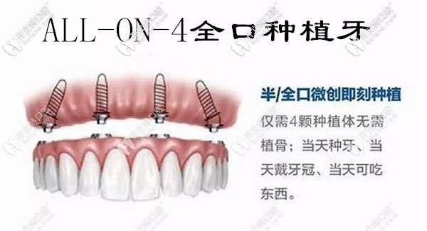 allon4全口种植牙 allon4全口种植牙