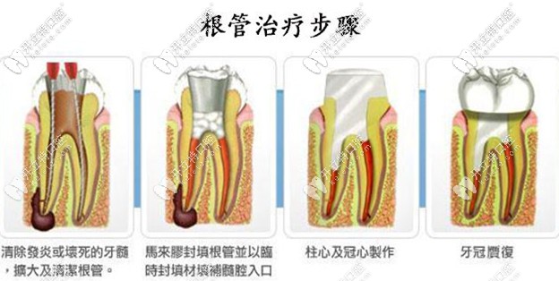 根管治疗的步骤