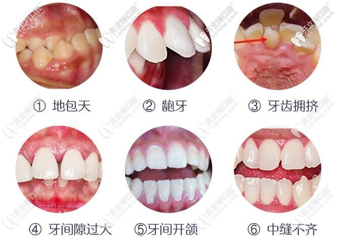 牙齿不齐的危害