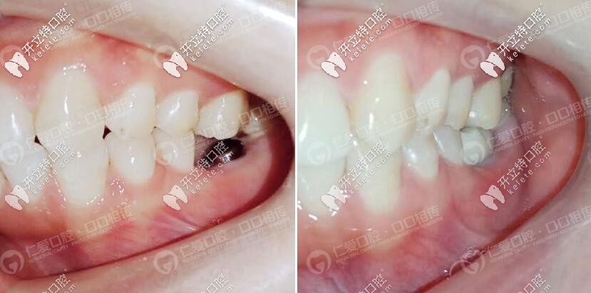 磨牙缺失恭喜自己在武汉私立牙科喜提一颗韩国登腾种植牙