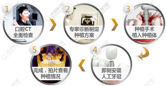 种植牙的过程 种植牙的过程