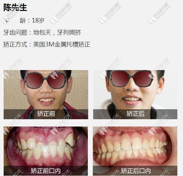深圳格伦菲尔口腔地包天牙齿矫正案例