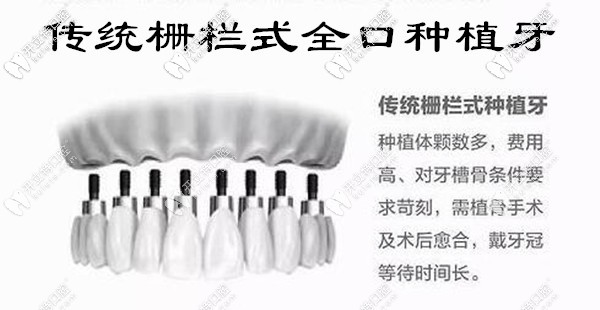 传统栅栏式全口种植牙 传统栅栏式全口种植牙