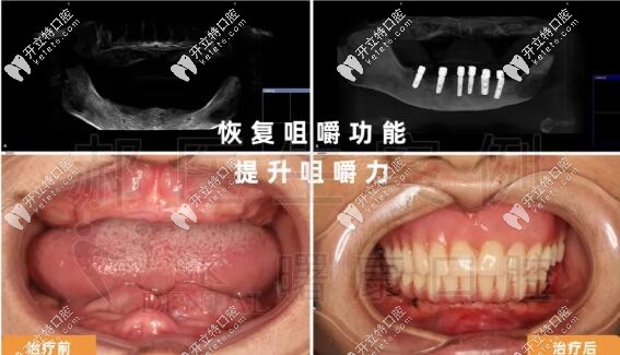 上海曙康下半口种植牙案例