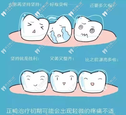 牙齿矫正戴牙套为什么会疼痛 牙齿矫正戴牙套为什么会疼痛