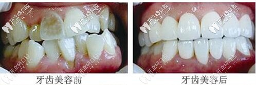 沈阳百嘉丽口腔牙齿美容案例