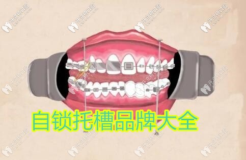 金属自锁牙套品牌大全汇总,说说国产和进口到底有啥区别？