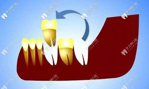 自体牙移植技术 