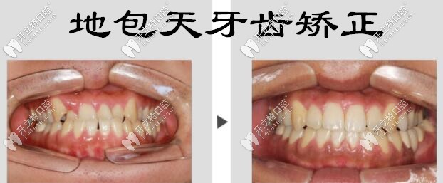 <!--<i data=20240703-sp></i>-->地包天牙齿矫正案例