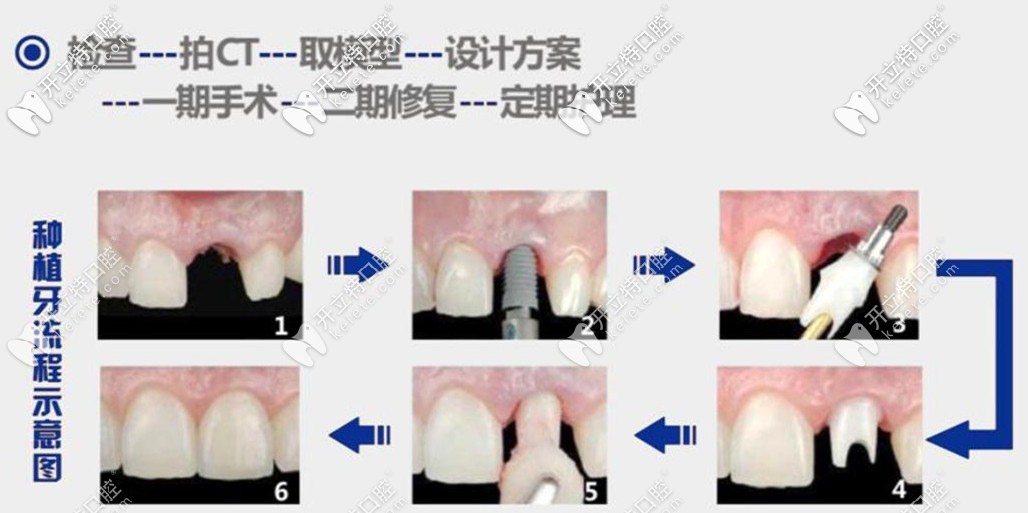 种植牙的流程示意图