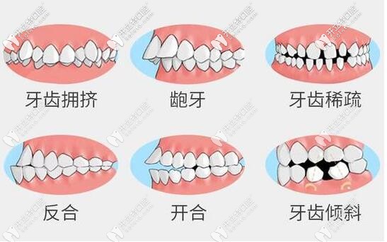 牙齿不齐的危害