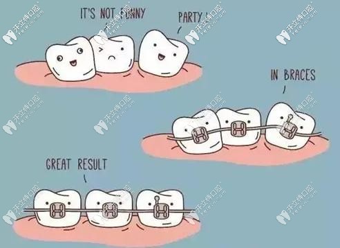 牙齿矫正一般需要多少时间