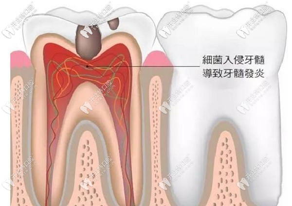 一次性根管治疗的适应症有哪些