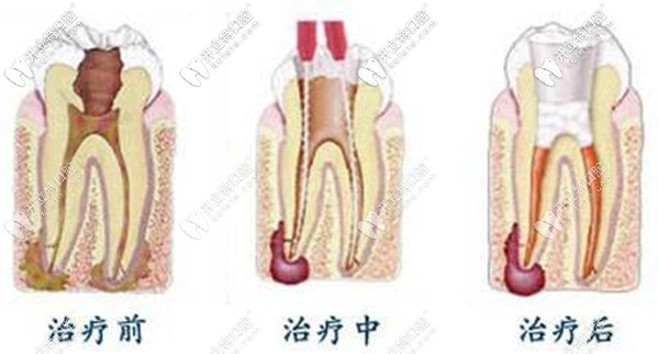 一次性根管治疗的步骤流程