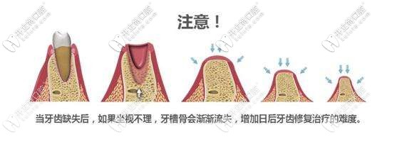 牙槽骨条件好可选择的种植体越多