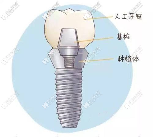 种植体的构造