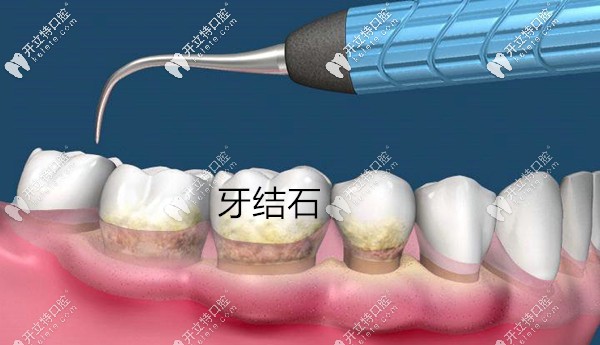 牙结石是牙周炎的致病因