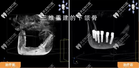 <!--<i data=20240703-sp></i>-->曙康全口all-on-6种植x线片前后对比