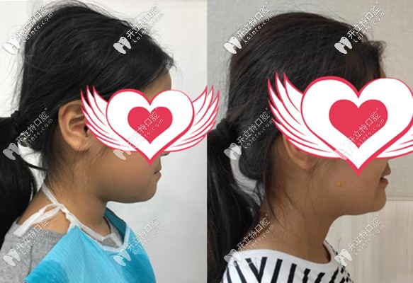 儿童反颌矫治前后容貌变化