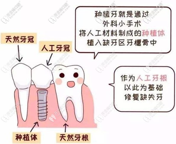 用图解说种植牙的特点