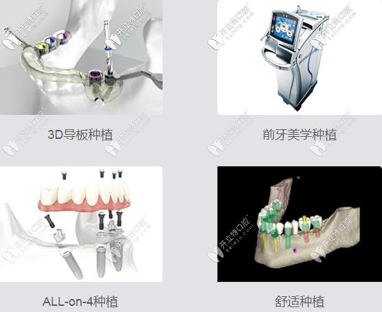 昆明美奥口腔4大种植技术