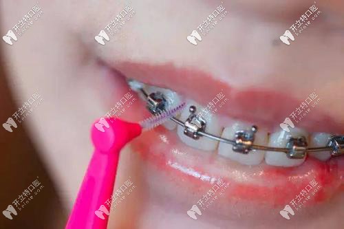 戴上固定钢牙套后要怎样清洁牙齿