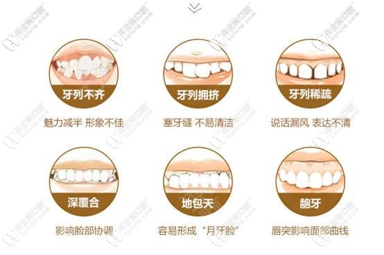 钢牙套矫正器适应症