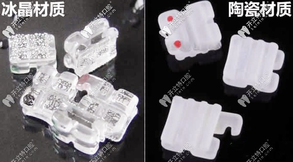 冰晶牙套矫正的价格