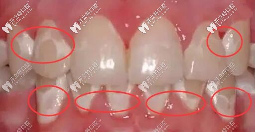 解疑：牙齿矫正中戴牙套会损伤牙釉质吗?