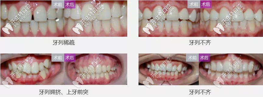 <!--<i data=20240703-sp></i>-->自锁托槽矫正案例