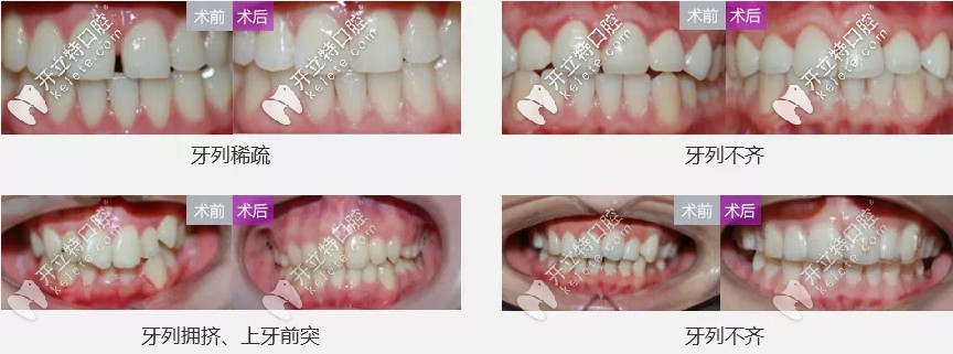 深圳世纪河山自锁托槽矫正案例