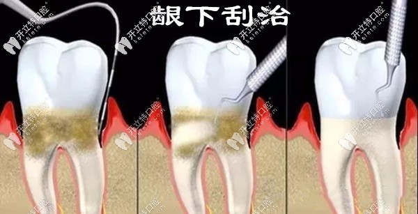 龈下牙结石怎么治疗