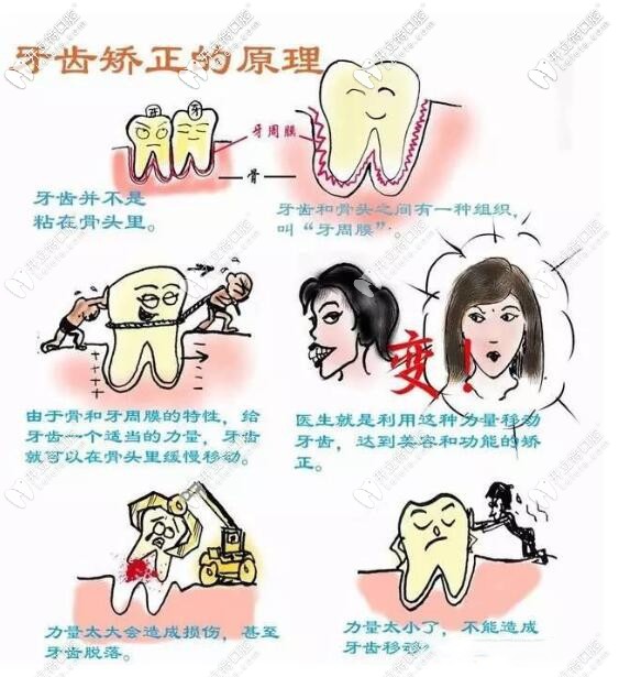 牙齿矫正原理