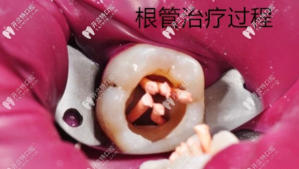 根管治疗中的牙齿