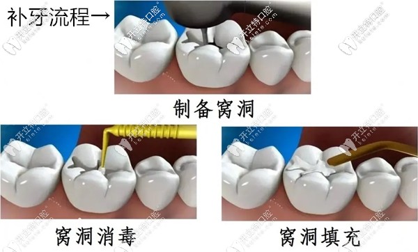 补牙的流程示意图