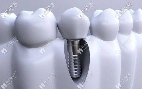 湖州鼎植口腔种植牙