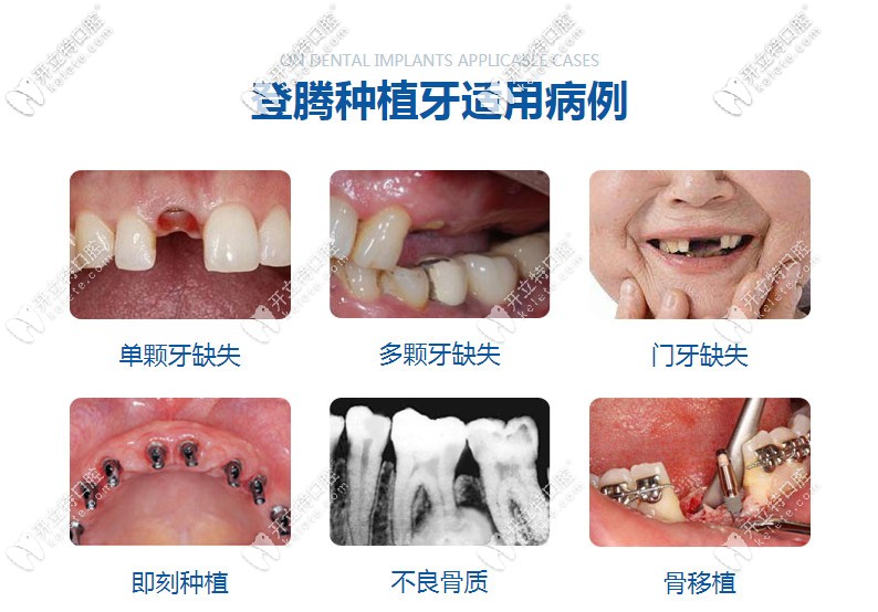 韩国登腾种植牙适用病例