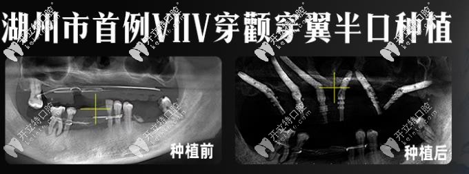 穿颧穿翼种植牙技术