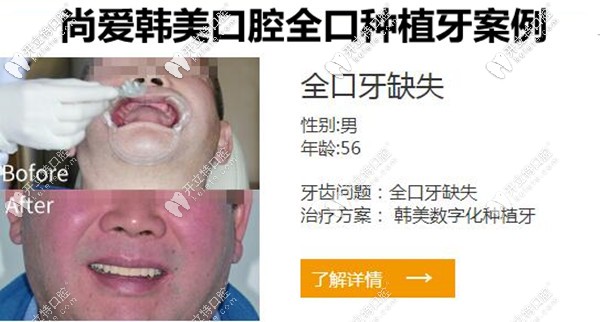 昆明尚爱韩美口腔全口种植牙案例