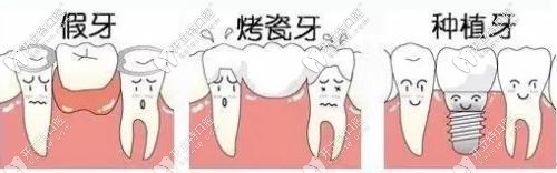 各种牙齿修复对比